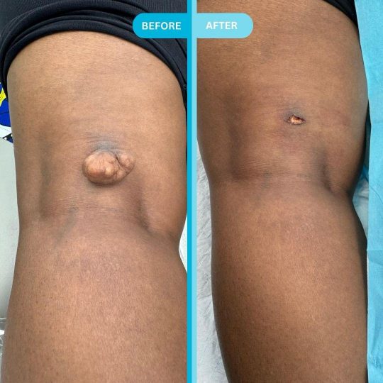 Acrochordon ( Dr Rubin )