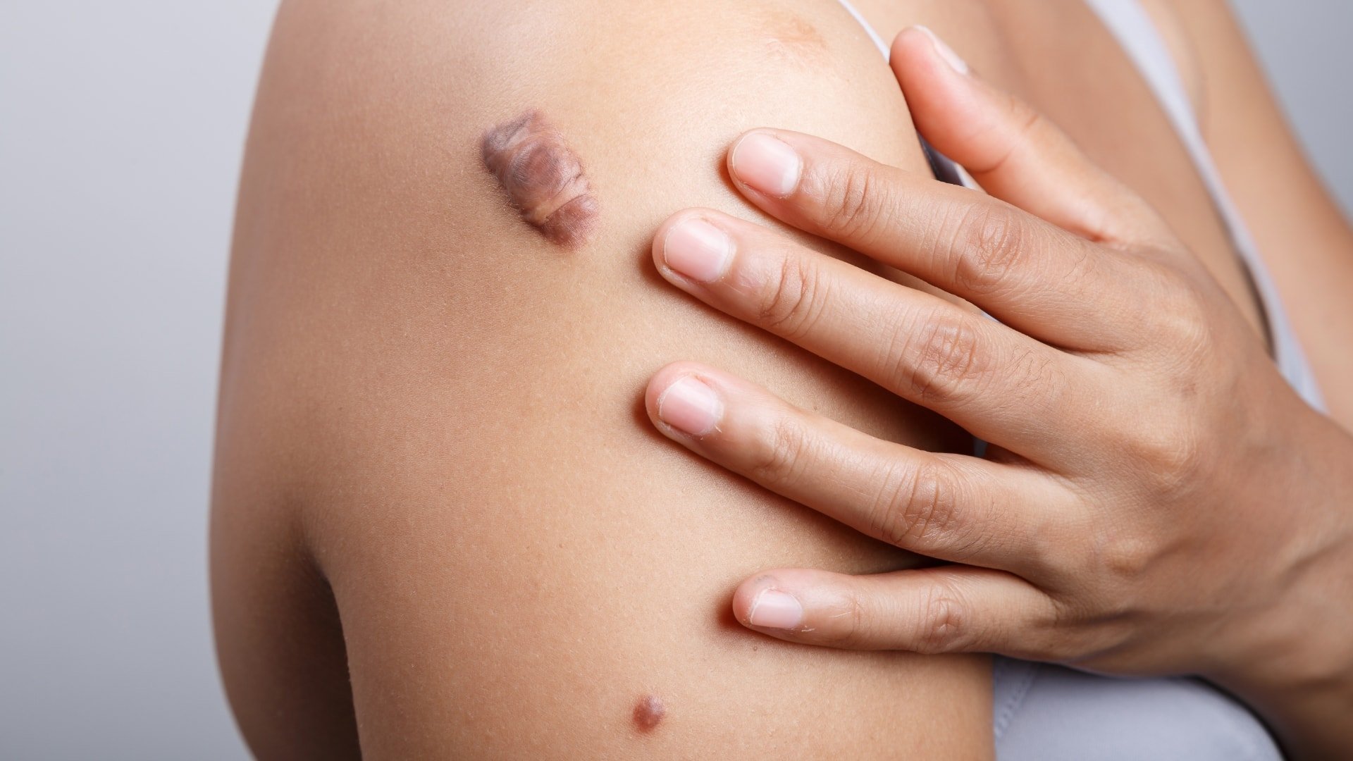 Keloids & Keloid Scars in Montreal, Laval,Ottawa & West Island