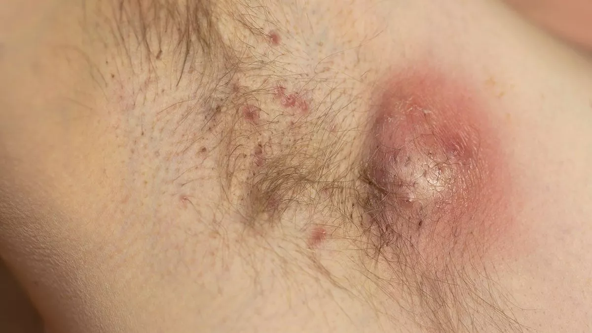 Hidradenitis Suppurativa Montreal, Ottawa, Laval and West Island