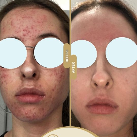 Acne scars





